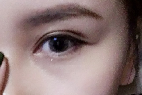 做雙眼皮多久冰敷一次？