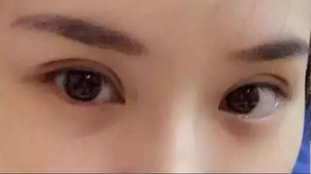 做雙眼皮對身體有沒有危害？