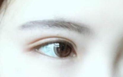 開眼角的恢復(fù)期要多長？