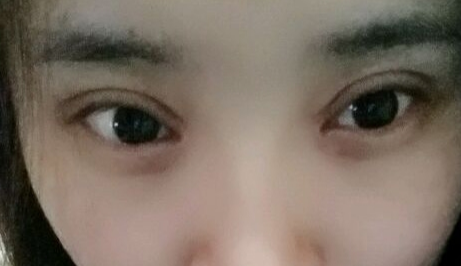 開眼角疼嗎？開眼角術(shù)后會留疤的原因有哪些？
