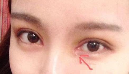 單眼皮開內(nèi)眼角會(huì)留疤嗎？