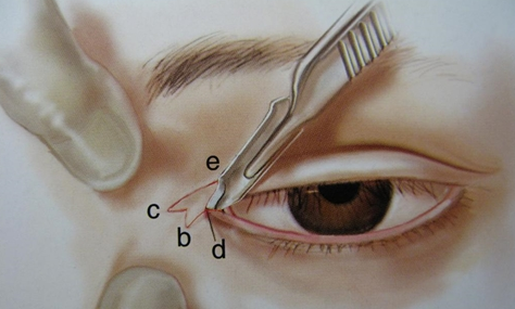 疤痕體質(zhì)可以割雙眼皮開眼角嗎？能一起做嗎