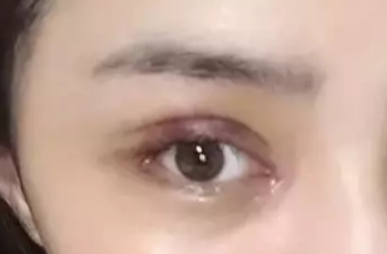 韓式開眼角失敗了怎么辦？