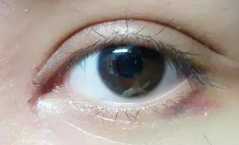 韓式開(kāi)眼角好嗎？韓式開(kāi)眼角術(shù)后怎么護(hù)理？