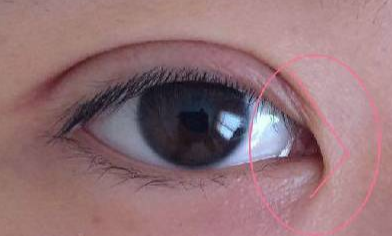 韓式開眼角恢復要多久？韓式開眼角術后有什么注意事項？