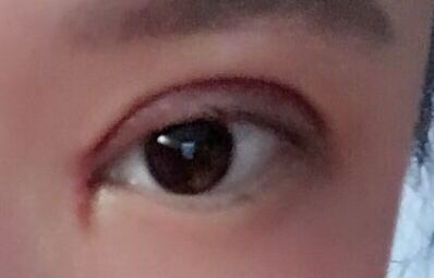 韓式開眼角手術(shù)有哪些優(yōu)勢(shì)？