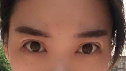 韓式開眼角的有副作用嗎？