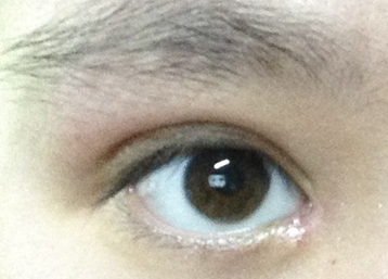 韓式開眼角的效果怎么樣？韓式開眼角失敗了怎么辦？