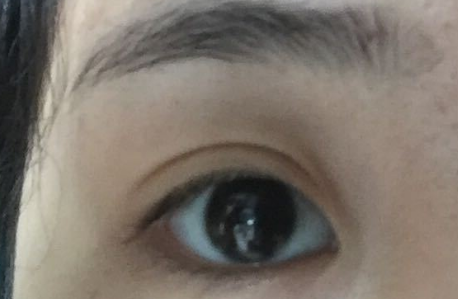 開內眼角拆線后變化明顯嗎？開內眼角會不會留疤？