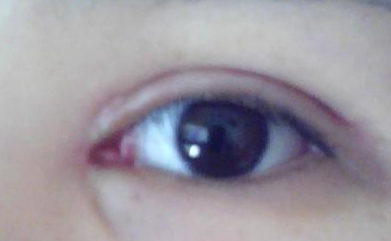 開外眼角拆線疼嗎？