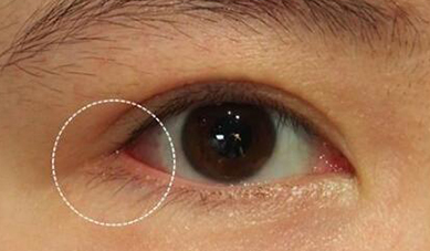 開內(nèi)眼角可能會(huì)出現(xiàn)什么后遺癥？