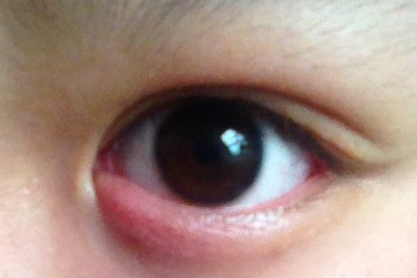 開內(nèi)外眼角的缺點有哪些？