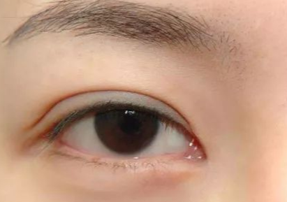 開內(nèi)外眼角多久能恢復(fù)好？開內(nèi)外眼角多少錢？
