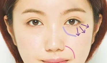 開內外眼角的效果如何？開內外眼角的缺點？