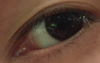 開眼角大概多少錢？開外眼角效果好不好？