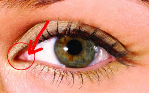 開內(nèi)眼角手術(shù)有什么效果？