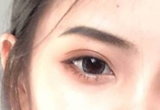 開(kāi)內(nèi)外眼角的恢復(fù)期是多久？