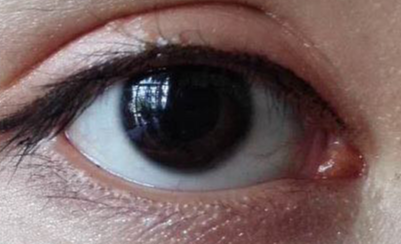 開眼角幾天能恢復？