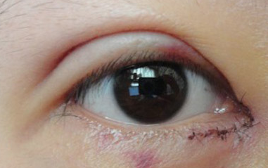 開內(nèi)眼角過程中會(huì)疼嗎？開內(nèi)眼角的風(fēng)險(xiǎn)有哪些？