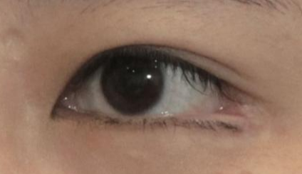 開內(nèi)眼角都會回縮嗎？