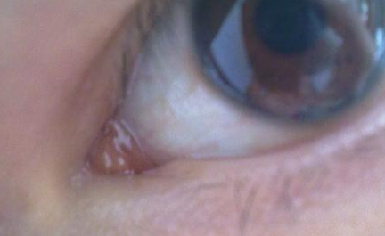 開(kāi)內(nèi)外眼角需要注意什么？