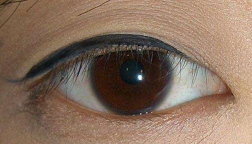 開(kāi)內(nèi)眼角的風(fēng)險(xiǎn)有哪些？