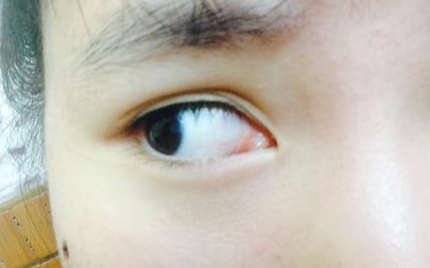 開內(nèi)眼角多久可以回縮？開內(nèi)眼角多久能消腫？