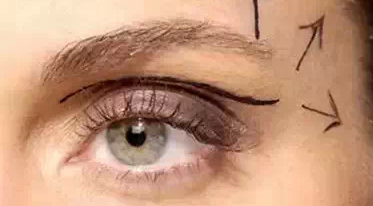 開內外眼角需要幾次？