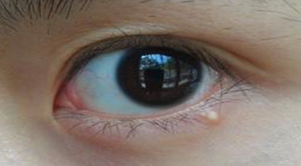 開內(nèi)外眼角手術(shù)是永久的嗎？