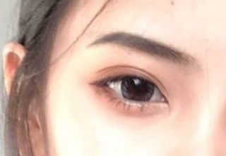 開內(nèi)外眼角怎么消腫快？開內(nèi)外眼角有什么壞處？