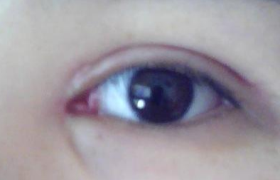 開內外眼角效果怎么樣？開內外眼角需要多長時間？