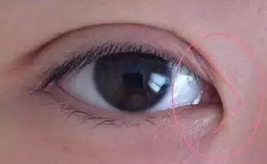 開內(nèi)眼角的作用有哪些？開內(nèi)眼角都會(huì)回縮嗎？
