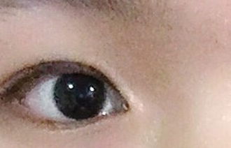 開內(nèi)眼角的危害有哪些？