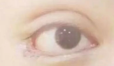 開內(nèi)眼角的效果好嗎？