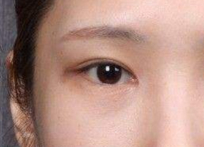 開內外眼角腫幾天？