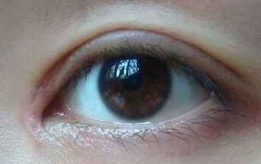 開內(nèi)眼角的禁忌癥是什么？