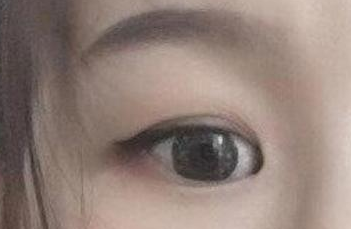 開內(nèi)眼角的手術(shù)費(fèi)用多少？