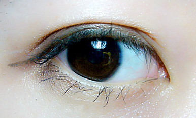 開內(nèi)眼角怎么避免并發(fā)癥？