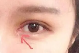 開眼角割雙眼皮拆線嗎？