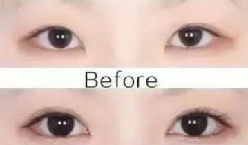 開眼角的危害大嗎？