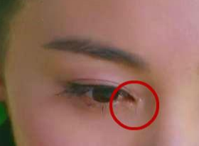 開眼角要增生多久？