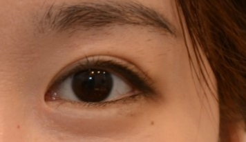 開眼角有效果嗎？開眼角有哪些危害？