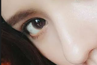 開(kāi)眼角有害嗎？