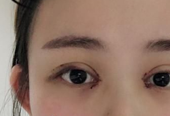開眼角后多長時(shí)間能恢復(fù)？