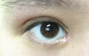 開眼角一定會出現(xiàn)疤痕嗎？