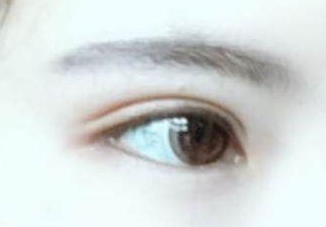 開眼角有沒有副作用？