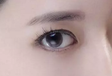 開(kāi)眼角術(shù)后會(huì)不會(huì)反彈？