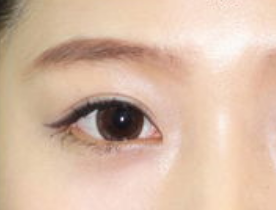 開眼角手術(shù)有哪些適應(yīng)人群呢？開眼角手術(shù)有哪些特點(diǎn)？