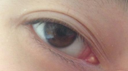 開眼角手術(shù)用不用冰敷？術(shù)后需要用拆線嗎？