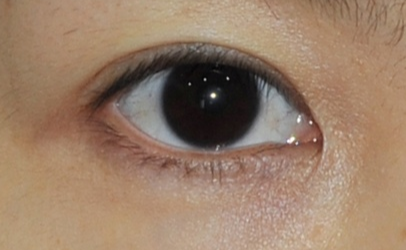 開外眼角的術(shù)后護理方法有哪些？開外眼角疼嗎？